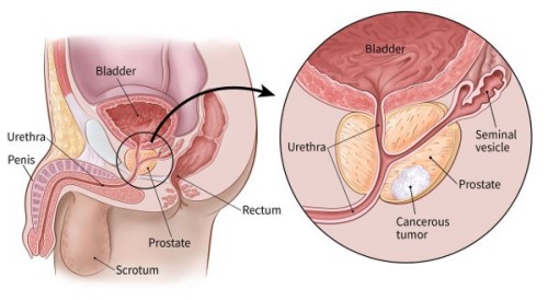 Delay in prostate treatment in men causes cancer