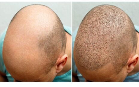 Transplant done for hair on bald head for marriage, death of young man of Bhilwara..
