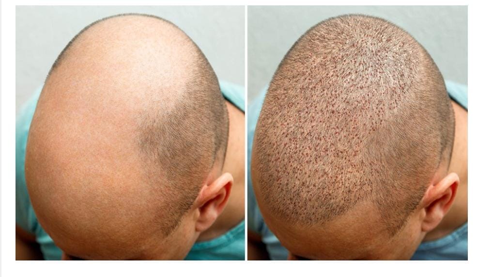 Transplant done for hair on bald head for marriage, death of young man of Bhilwara..